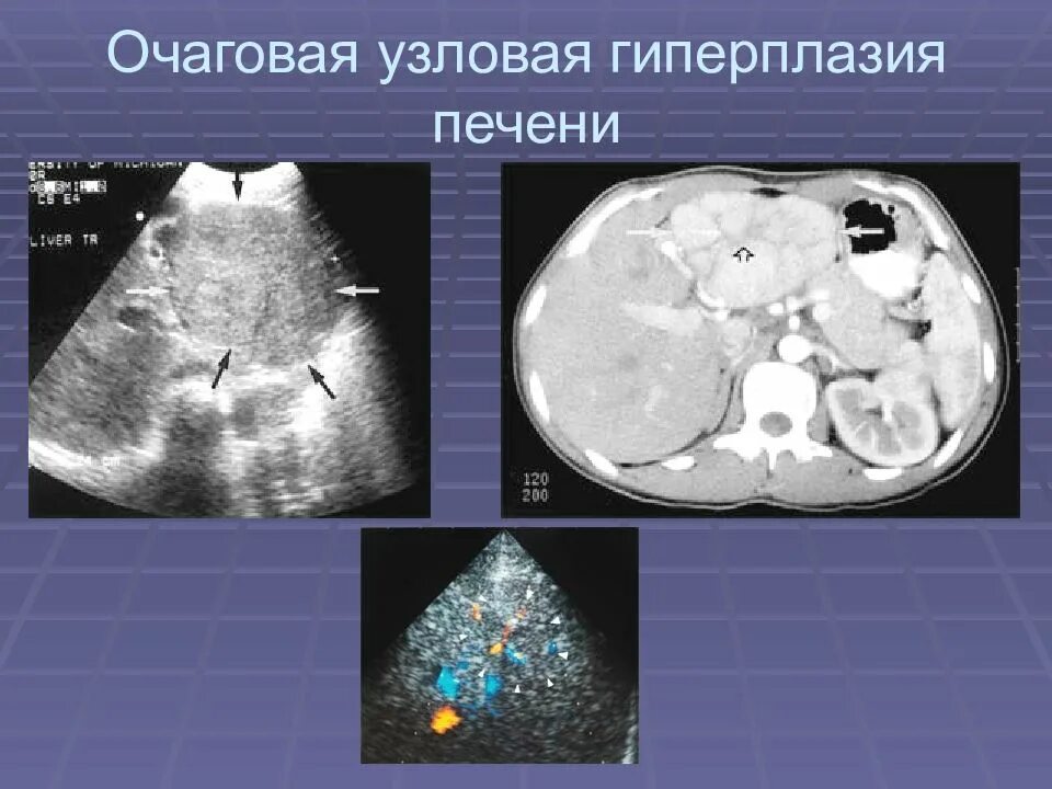 Фокальная гиперплазия печени. Нодулярная гиперплазия печени на кт. Очаговая нодулярная гиперплазия печени УЗИ. Очаговая гиперплазия печени на УЗИ. Фокальная нодулярная гиперплазия печени на УЗИ.