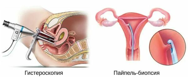 Биопсия полости матки. Вакуум-аспирация эндометрия пайпель-биопсия. Пайпель-биопсия (аспирационная биопсия). Пайпель аспирация матки.