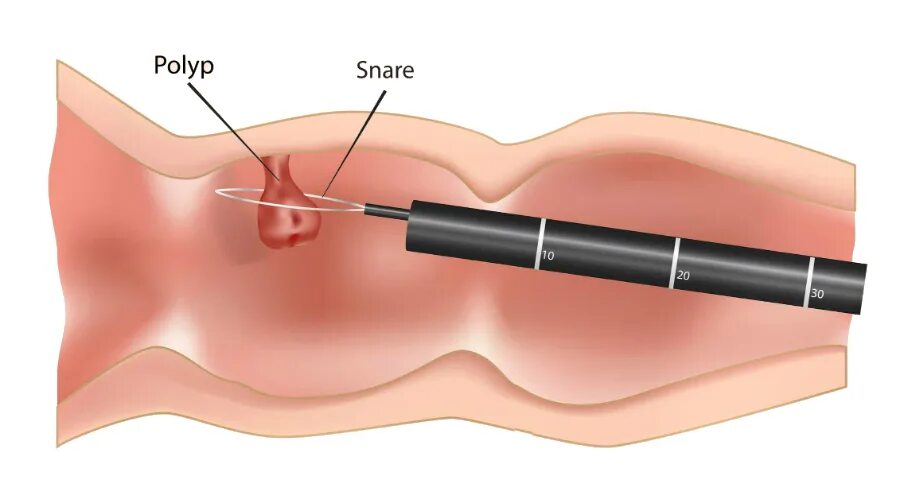 Биоптат кишки. Гистероскопия полипэктомия. Полип эндометрия гистероскопия. Гистероскопия с биопсией.