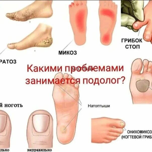 Грибок ногтей на ногах: общие симптомы, особенности лечение, применяемые препара