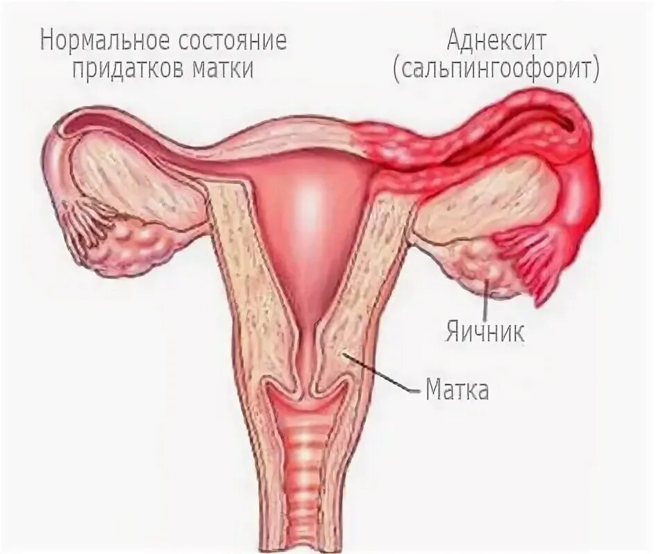 Болят ли придатки. Сальпингоофорит (аднексит).