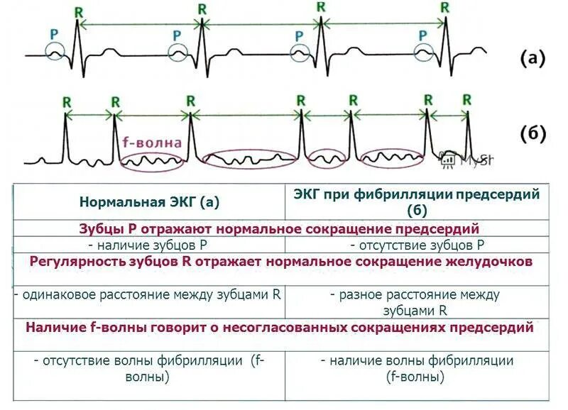 Мерцательная аритмия фибрилляция предсердий симптомы. Пароксизмальная фибрилляция предсердий на экг. волны фибрилляции на экг. трепетание предсердий на экг волны f. экг при пароксизме фибрилляции предсердий.
