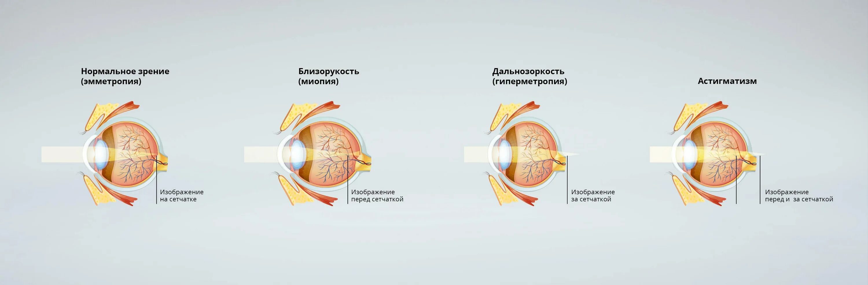 1 это нормальное зрение. Миопия дальнозоркость астигматизм. Миопия глазное яблоко. Миопия гиперметропия астигматизм пресбиопия. Близорукость форма глазного яблока.