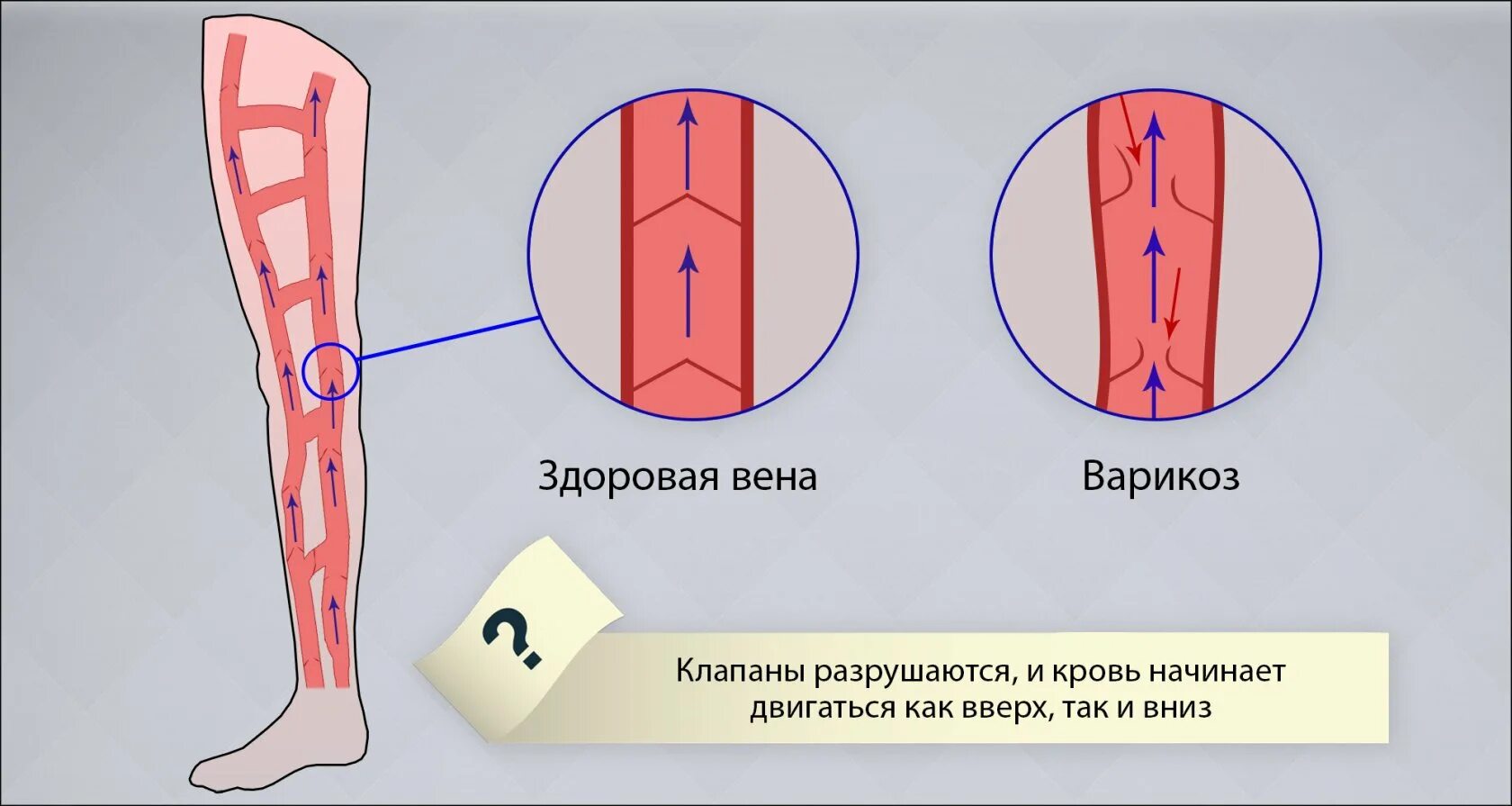 Вены ног клапаны. Клапаны вен нижних конечностей. Расположение клапанов в венах нижних конечностей. Венозный клапан нижних конечностей.