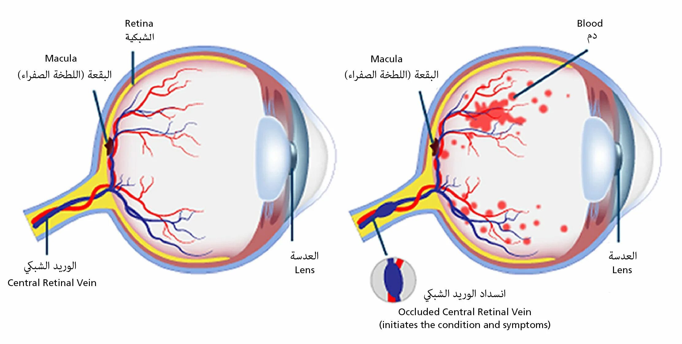 Центральная Вена сетчатки. Тромбоз Центральный Вена сетчатке глаза. Классификация тромбоза центральной вены сетчатки. Симптомы тромбоза центральной вены сетчатки.