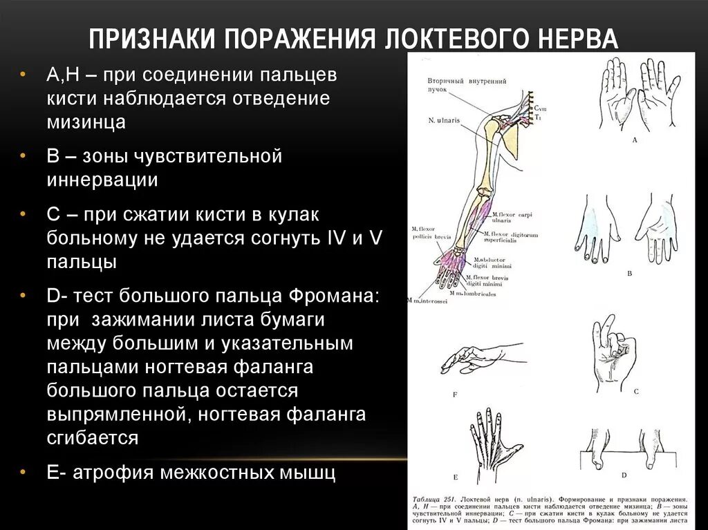 Поражение 3 нерва. Нейропатия локтевого нерва клиника. Поражение лучевого нерва неврология. Симптомы поражения локтевого нерва нерва. Клиника поражения локтевого нерва.