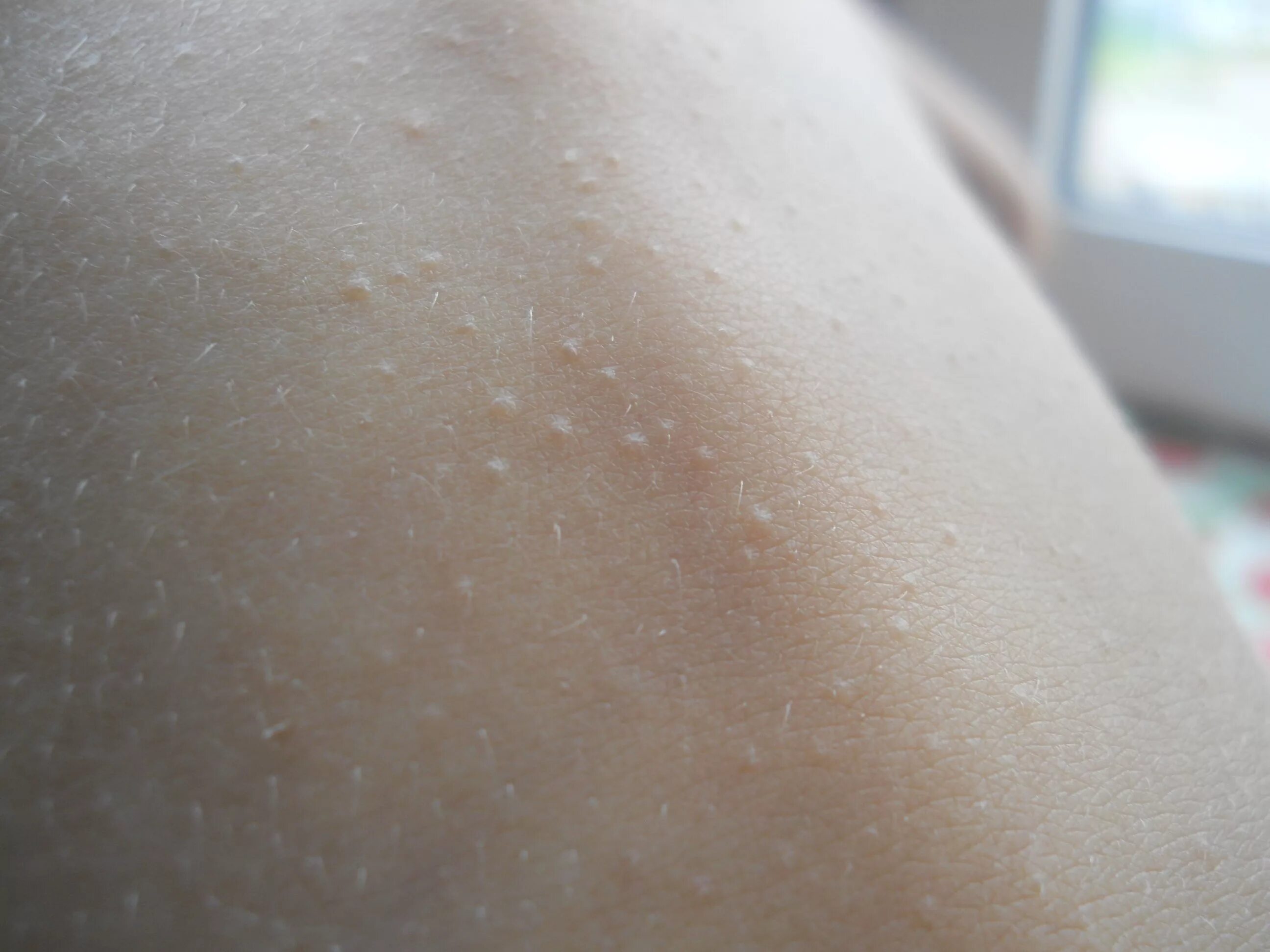 мелкие бесцветные. мелкие бесцветные прыщики. мелкие белые прыщики на руках. мелкие бесцветные. мелкие бесцветные.