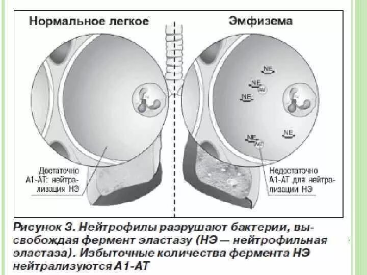 Дефицит Альфа 1 антитрипсина патогенез. Недостаточность Альфа 1 антитрипсина патогенез. Врожденный дефицит альфа1-антитрипсина. Дефицит Альфа 1 антитрипсина печень. Альфа 1а