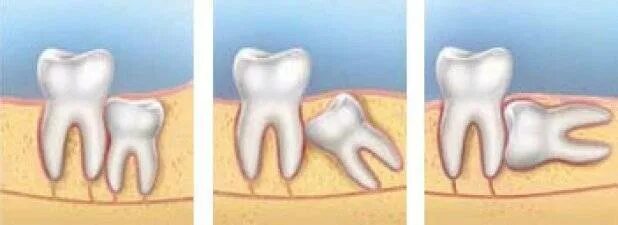 Лечение зуба 8. Ретинированная восьмерка зуб. Ретинированный зуб мудрости.