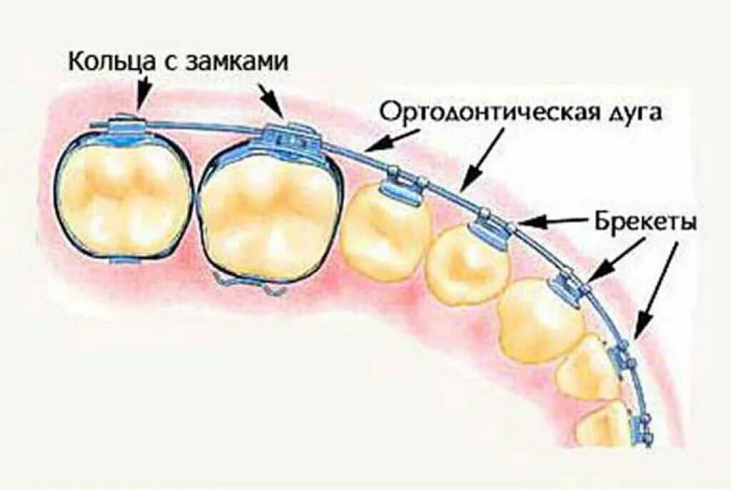 Угол дуги окружности. Нужна ли дуга. Нужна ли дуга. Как найти друг в окружности. Брекеты ортодонтия строение.