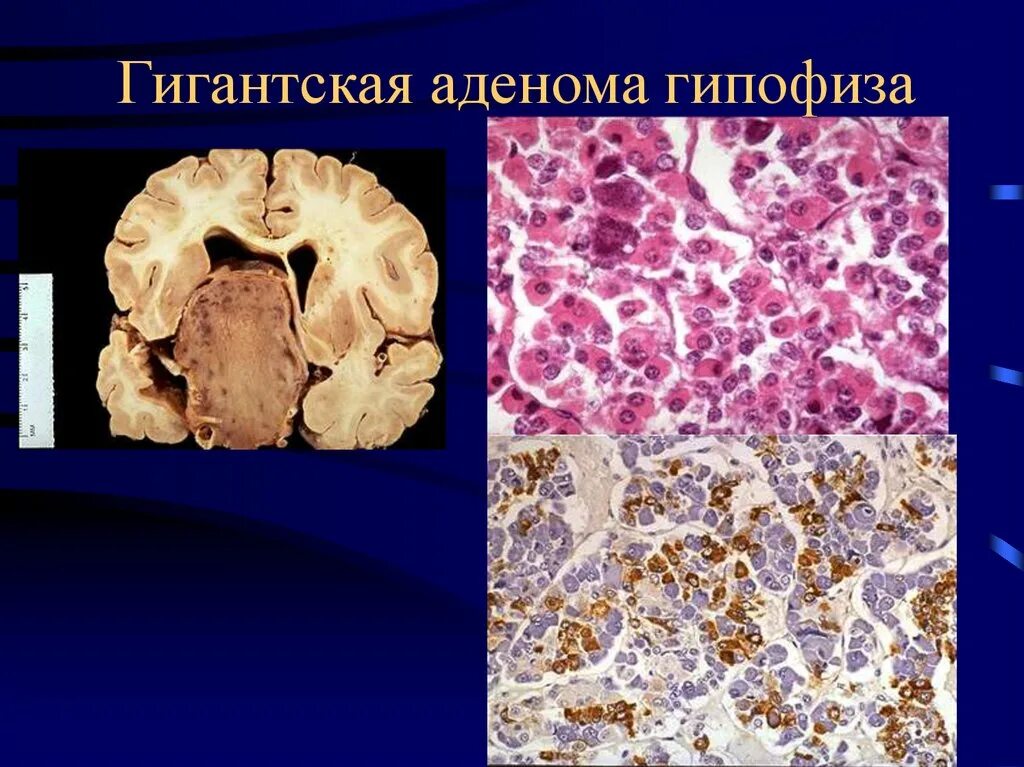 Базофильная аденома гипофиза микропрепарат. Базофильная аденома. Аденома гипофиза препарат патанатомия. Хромофобная аденома гипофиза микропрепарат. Эозинофильная аденома.