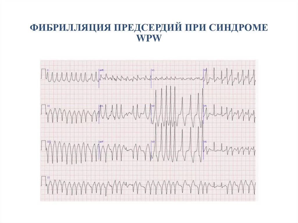Фибрилляция форум. Фибрилляция предсердий wpw экг. фибрилляция предсердий при впв синдроме. фибрилляция предсердий холтер. фибрилляция предсердий при синдроме wpw характеризуется.