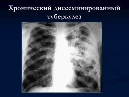 Диагностика туберкулеза рентген