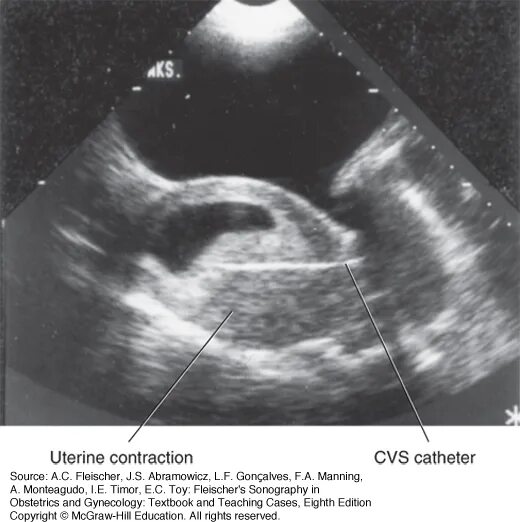 Тонус передней стенки матки. Гипертонус миометрия задней стенки матки при беременности. Гипертонус матки по УЗИ. Локальный гипертонус миометрия.