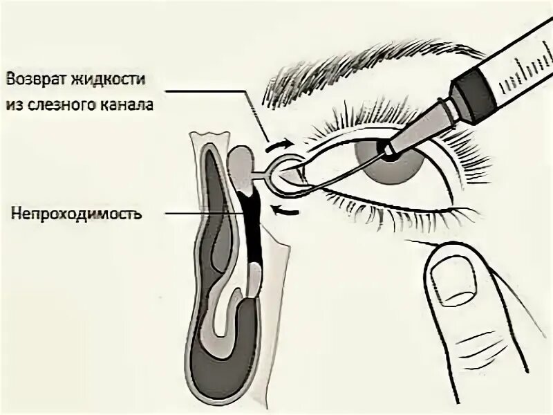 Как прочистить слезные каналы. Дакриоцистит воспаление слезных мешков. Лечение воспаления слезного мешка дакриоцистит. Носослезный мешок воспаление. Зондирование слезного канала.