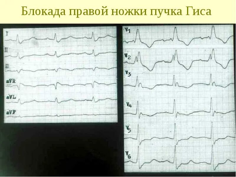 Блокада левой ножки пучка гиса на экг. Полная блокада правой ножки. Блокада ножек пучка гиса на экг. Блокада правая ножка пучка гиса. Экг 12 отведений блокада левой ножки пучка гиса.