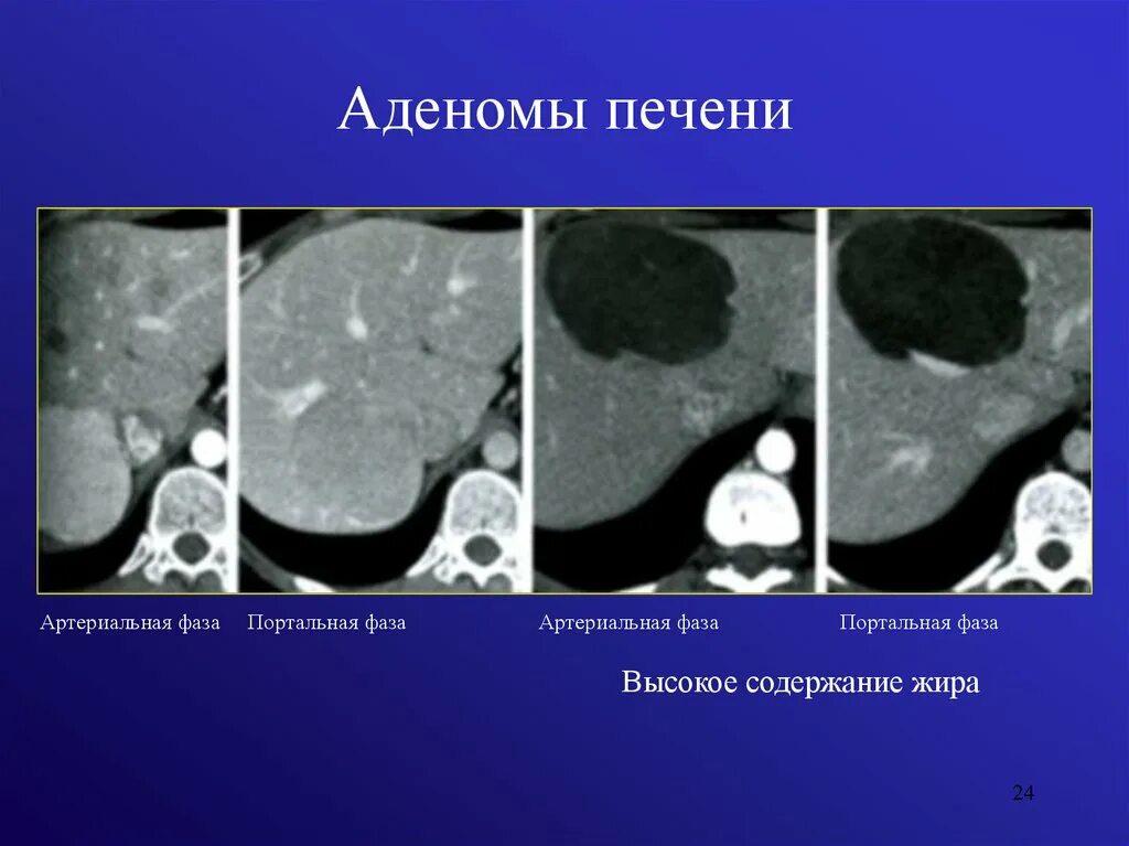 Аденома печени мрт. Гепатоцеллюлярная аденома мрт. Аденома печени мрт. Гепатоцеллюлярная аденома печени кт. Гепатоцеллюлярная аденома печени кт.