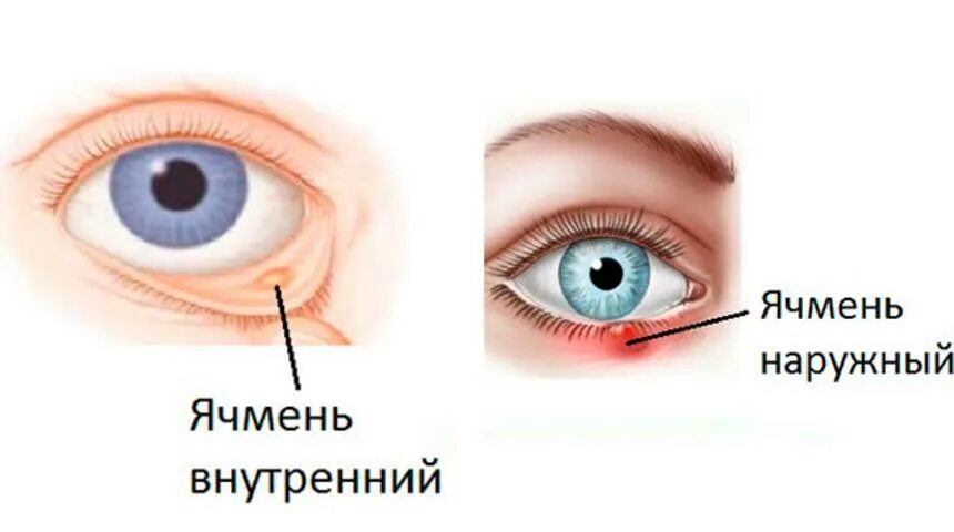 Как вылечить ячмень у ребенка. Абсцедирующий ячмень нижнего века. внутренний ячмень офтальмология. наружный и внутренний ячмень. внутренний и внешний ячмень.