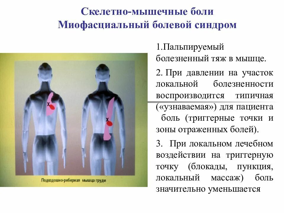 Миофасциальный синдром. Миофасциальный синдом. Ниопосцеальные болевой синдром. Мио-фасцимерный синдром.