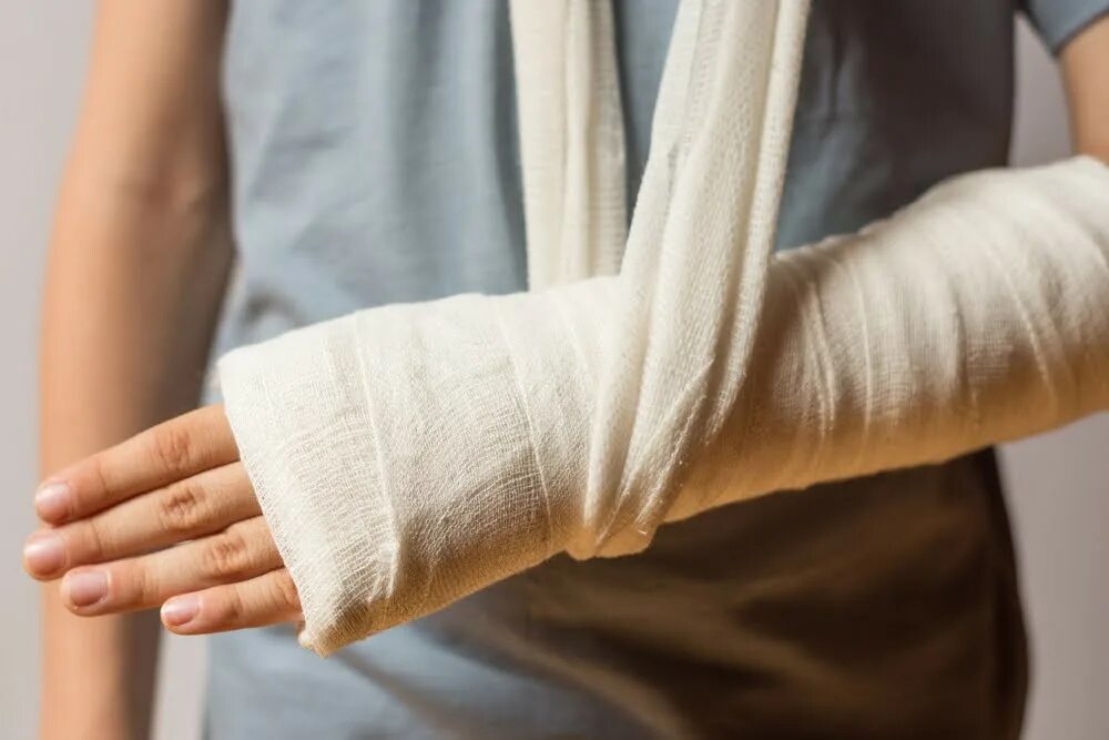 К чему снится сломанная рука. Кокситные гипсовые повязки. Видеть во сне сломанные руки. Видеть во сне сломанные руки. Перелом ноги ниже колена.