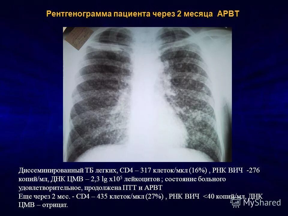 Бисептол пневмоцистная пневмония. Профилактика спид вич туберкулез. Вич легких. Вич легких. Пневмоцистная пневмония при вич инфекции.