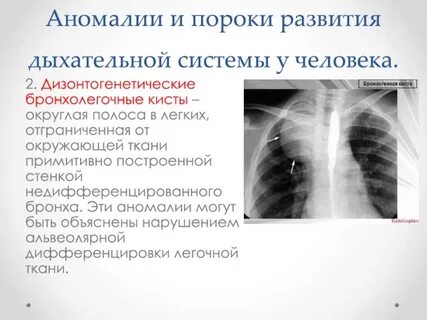 Пороки бронхолегочной системы