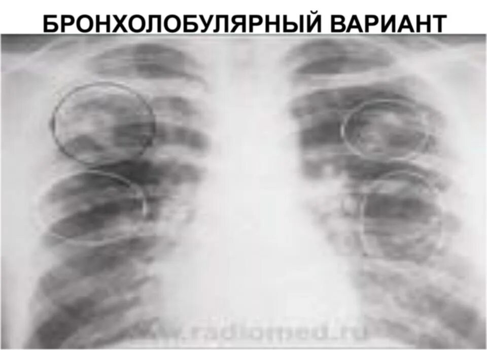 Occult pneumonia - Wikipedia