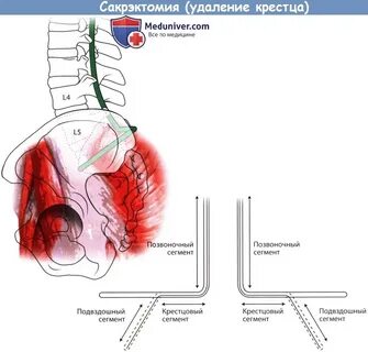Удаление крестцовой грыжи