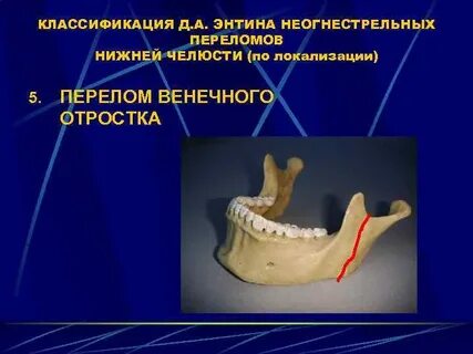 Клинические рекомендации перелом нижней челюсти