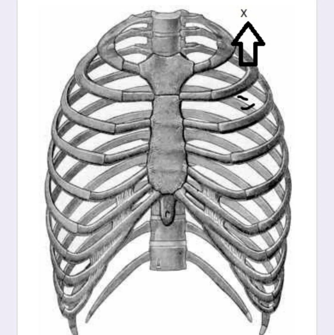 Хондрит грудино реберный. Грудная клетка скелет 12 ребер. Грудная клетка Грудина и ребра анатомия 8. Хондрит реберный 5 ребро. Ребра трубчатые