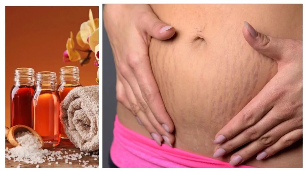 Форум масло при беременности. Растяжки беременность. Растяжки при беременности масло. Оливковое масло для растяжек. Масло от растяжек на животе.
