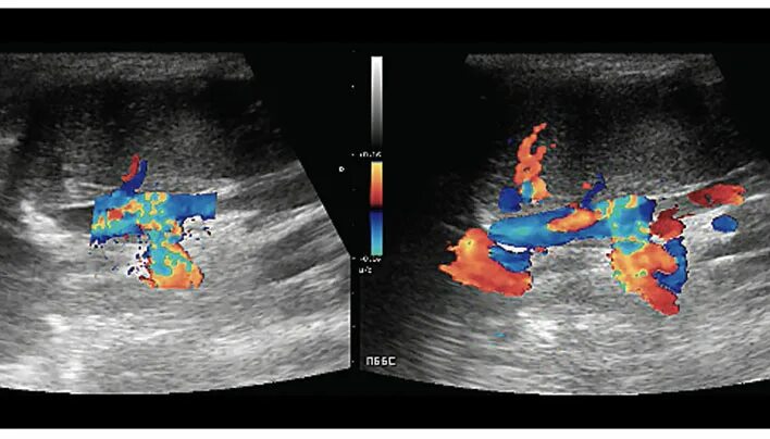 Портосистемные шунты УЗИ. Портокавальный шунт УЗИ. Портосистемный шунт у собак УЗИ.