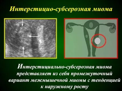 Размеры интрамуральных узлов