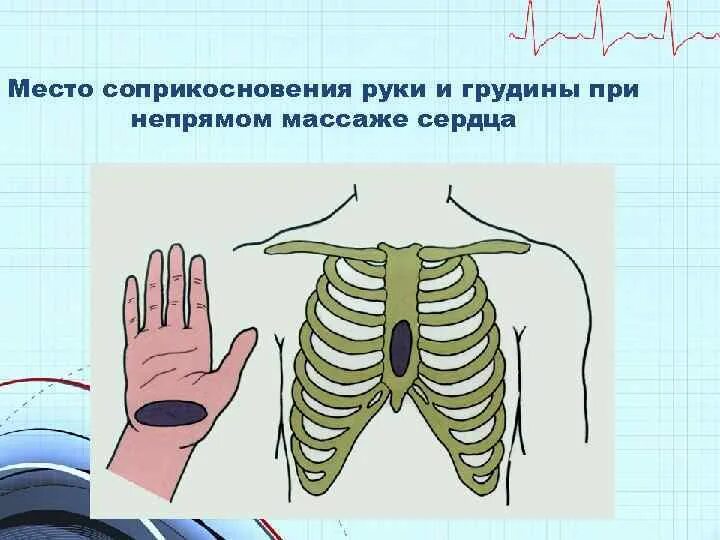 Место приложения усилий при непрямом массаже. Место соприкосновения руки и грудины при непрямом массаже сердца. место соприкосновения руки и грудины. руки на грудину при непрямом массаже. смещаемость грудины при непрямом массаже.