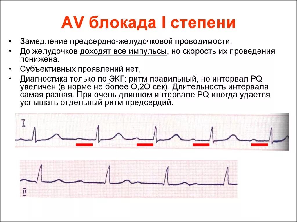 ЭКГ при атриовентрикулярной блокаде 1 степени. Атриовентрикулярная блокада 1 степени на ЭКГ. АВ блокада 1 степени на ЭКГ. Антро вентрикулярная блокада 1 степени. Что значит av