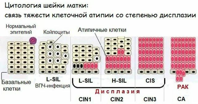 Что такое жидкостная цитология шейки матки. Жидкостная цитология расшифровка. Жидкостная цитология шейки. Жидкостная цитология Результаты расшифровка. Жидкостная цитология шейки матки расшифровка результатов.