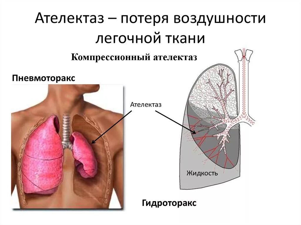Спадение бронха