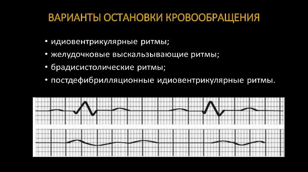 Самый распространенный вариант остановки кровообращения у детей:. Виды остановки кровообращения на ЭКГ. ЭКГ при остановке кровообращения.