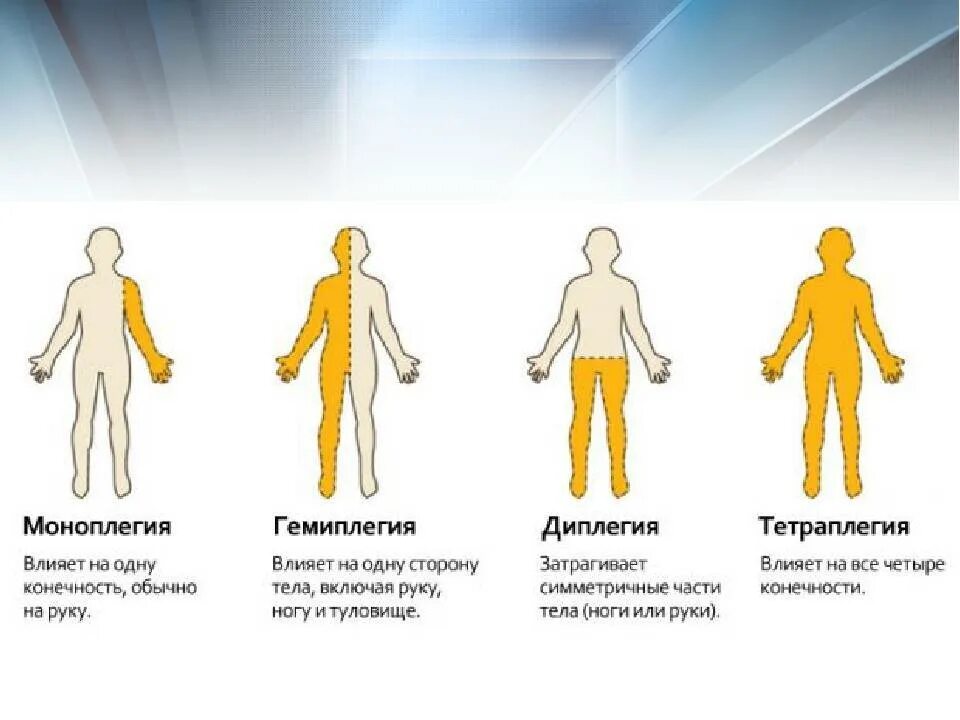 Дцп диплегия. Синдром центрального правостороннего гемипареза. Гемипарез парапарез моноплегия. Левосторонний гемипарез поражение.