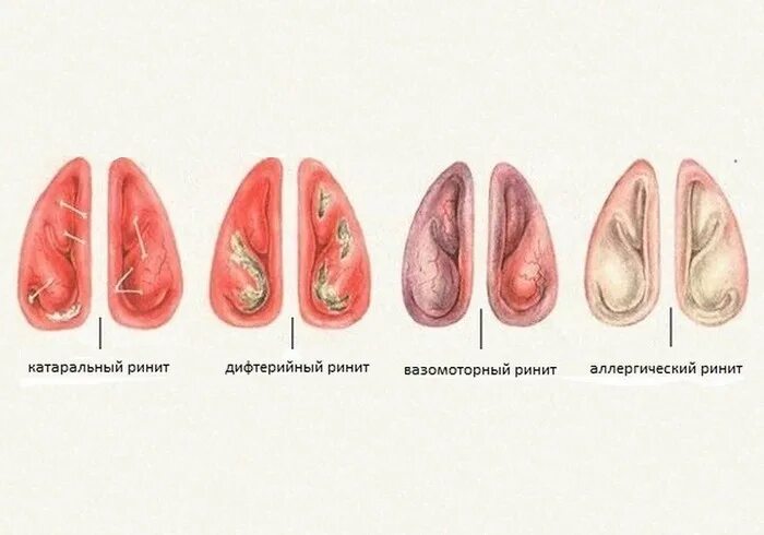 Вазомоторный гипертрофический ринит. Хронический вазомоторный ринит. Отечно катаральный ринит. Вазомоторный ринит риноскопия. Острый катаральный ринит