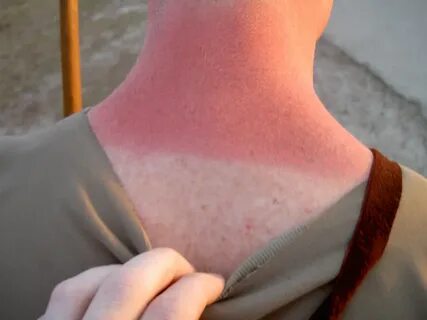 Сколько проходит загар от солнца