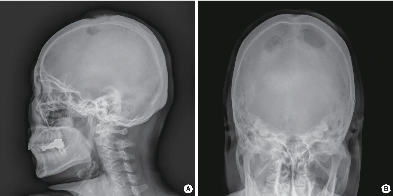 Трещина в голове. Остеома затылочной кости рентген. Остеома затылочной кости черепа рентген. Хондрома костей черепа кт. Остеома лобной рентген.