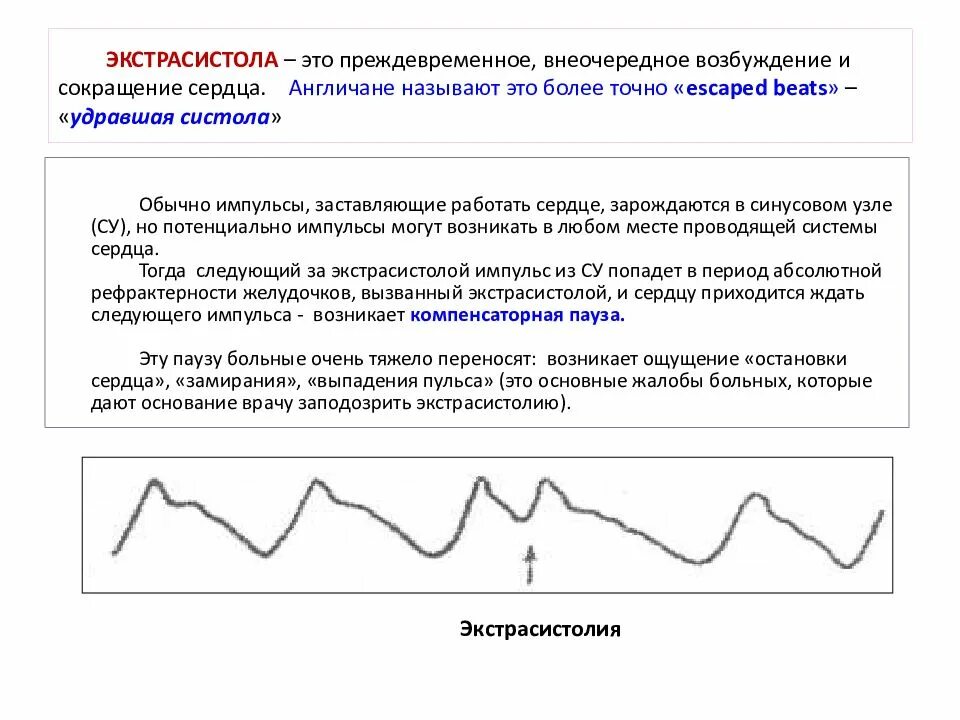 Пульс экстрасистолы