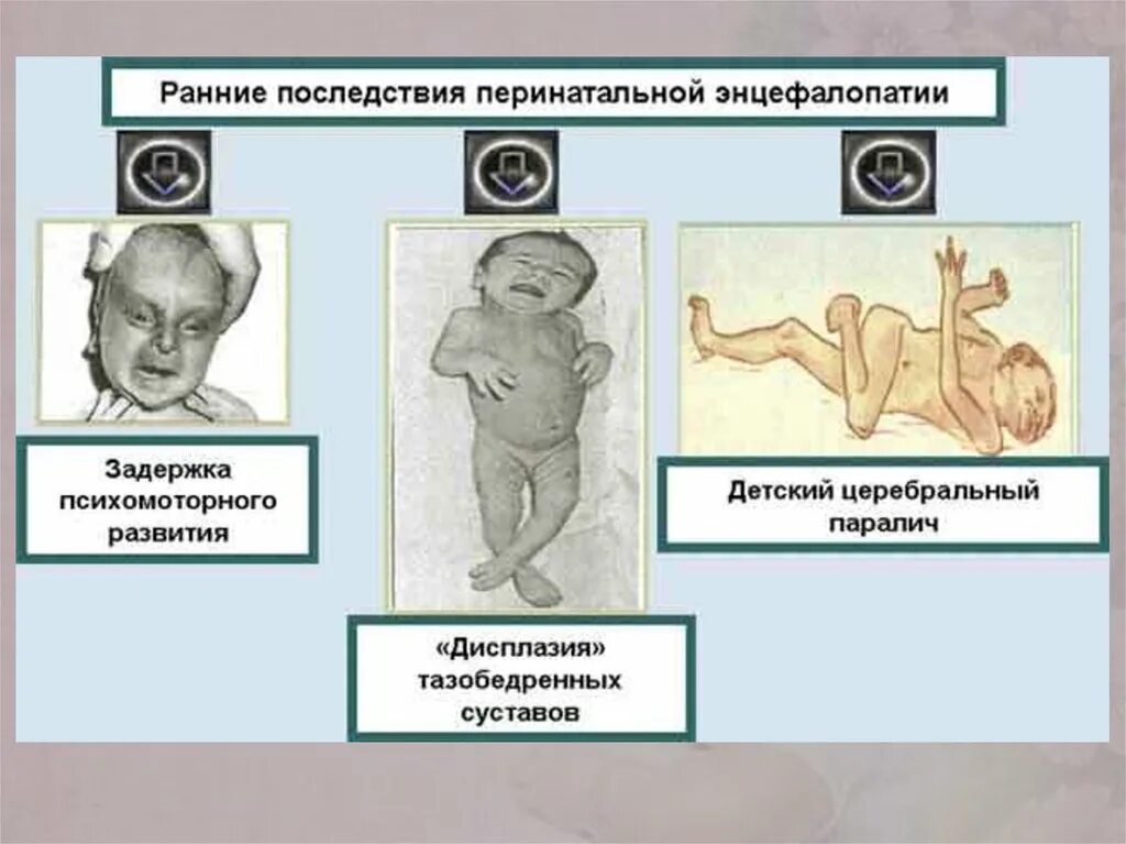 Энцефалопатия неуточненная у ребенка что это. Энцефалопатия у детей симптомы. Перинатальная энцефалопатия диагноз. Перинатальная энцефалопатия у новорожденных. ; Перинатальная энцефалопатия (ПЭП)..