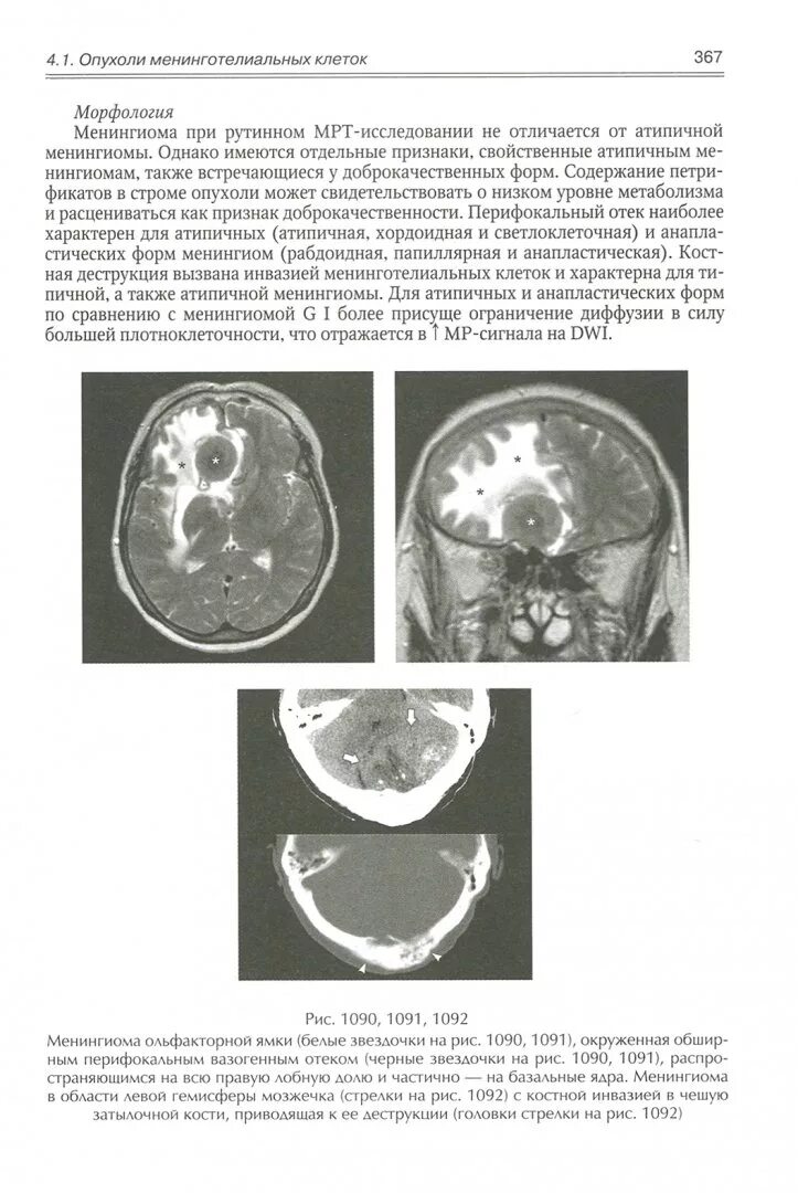Анапластическая менингиома мрт. Книги опухоль