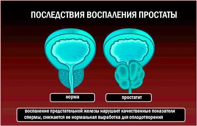 Простатит симптомы и последствия. Воспаление предстательной железы. воспаление предстательной железы у мужчин. хронический простатит.