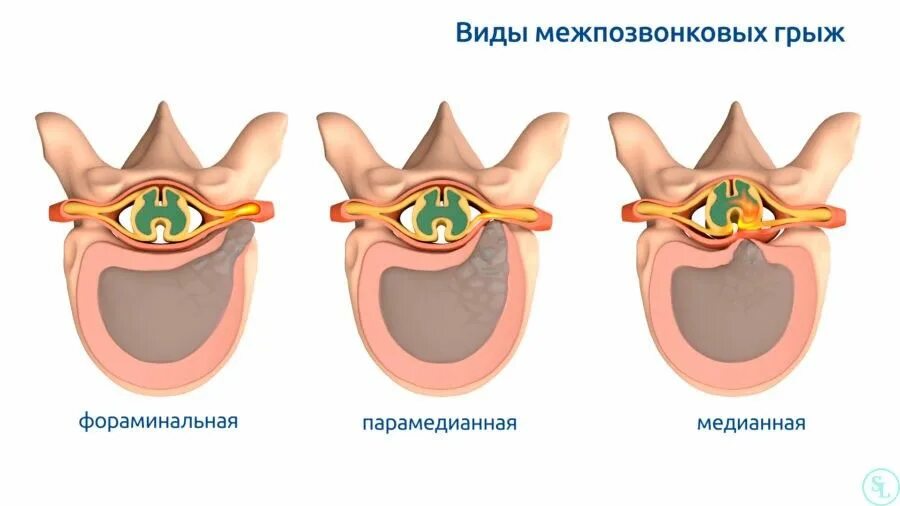 Межпозвонковая грыжа парамедианная. Медианно-парамедианная протрузия диска. Медианная грыжа межпозвонкового диска. Задняя парамедианная грыжа l5.