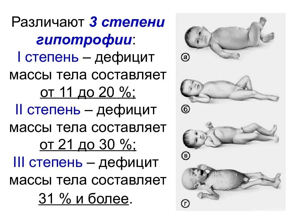 Ребенок отстает на неделю. Гипотрофия 1 степени у новорожденного. Пренатальная гипотрофия 1 степени у новорожденных. Дефицит массы тела при гипотрофии 3 степени. Гипотрофия 2 степени у детей дефицит массы.