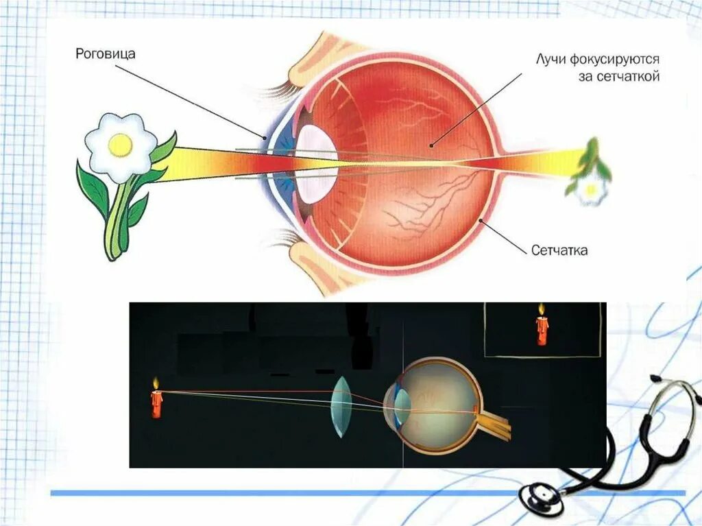 Дополните предложения изображение в близоруком глазу фокусируется