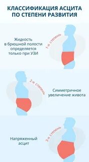 Что такое брюшная водянка